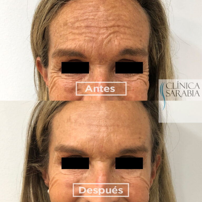 Subida ANTES y DESPUES Botox 1