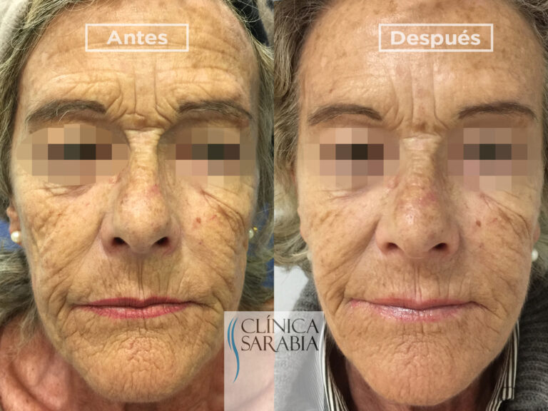 Subida ANTES y DESPUES Ellanse 1