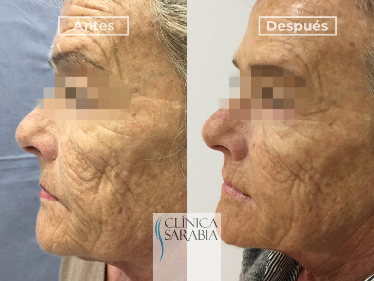 Subida ANTES y DESPUES Ellanse 3