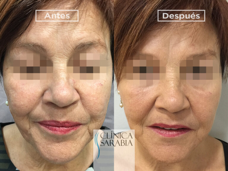 Subida ANTES y DESPUES Ellanse 4