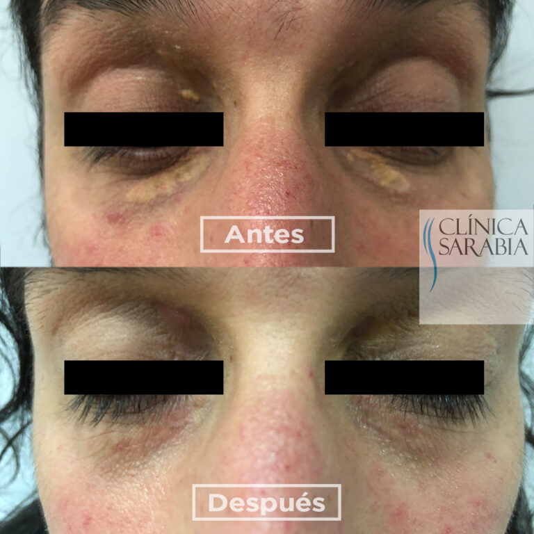 Subida ANTES y DESPUES Xantelasmas 1