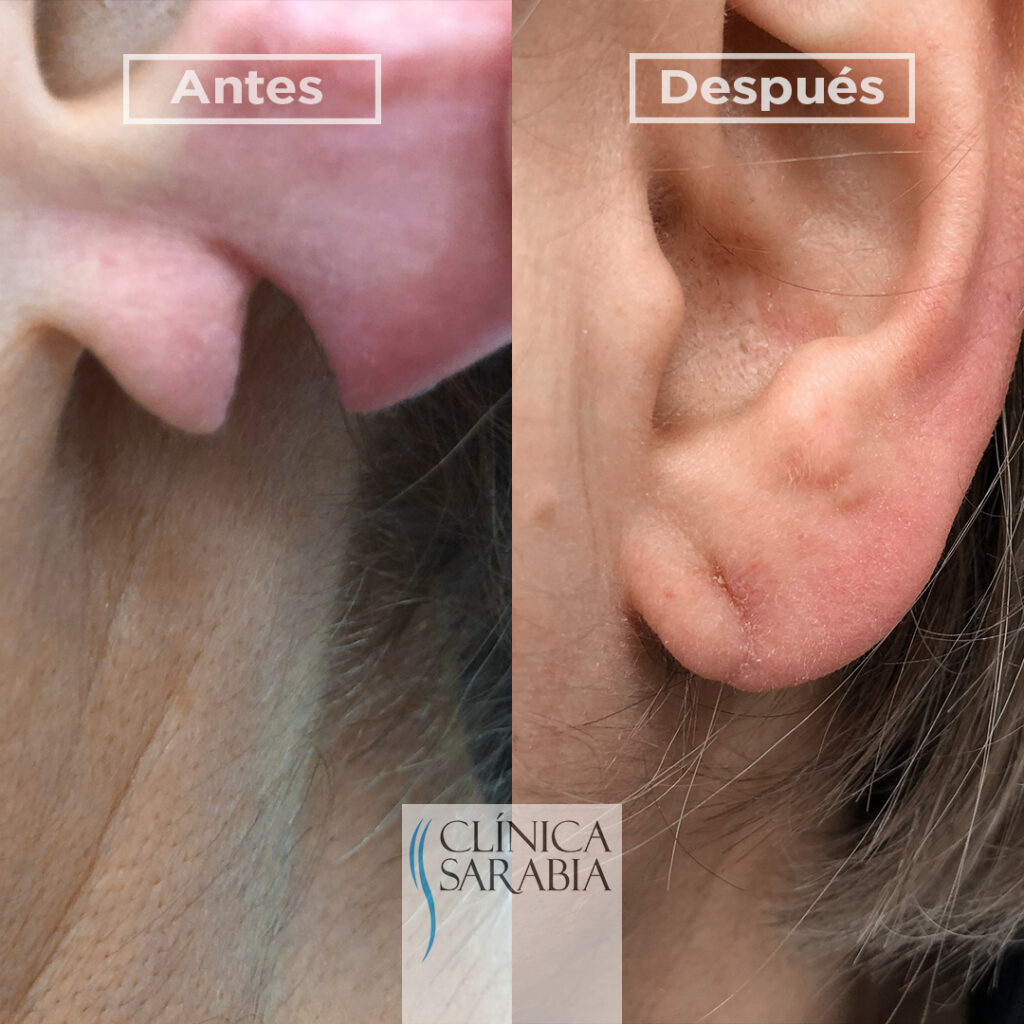 Subida ANTES y DESPUES lobulos orejas