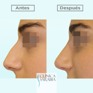 Especialistas en rinoplastia en Bilbao 3 Subida ANTES y DESPUES rinoplastia 2