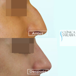 Especialistas en rinoplastia en Bilbao 2 Precio- información sobre rinoplastia en Bilbao
