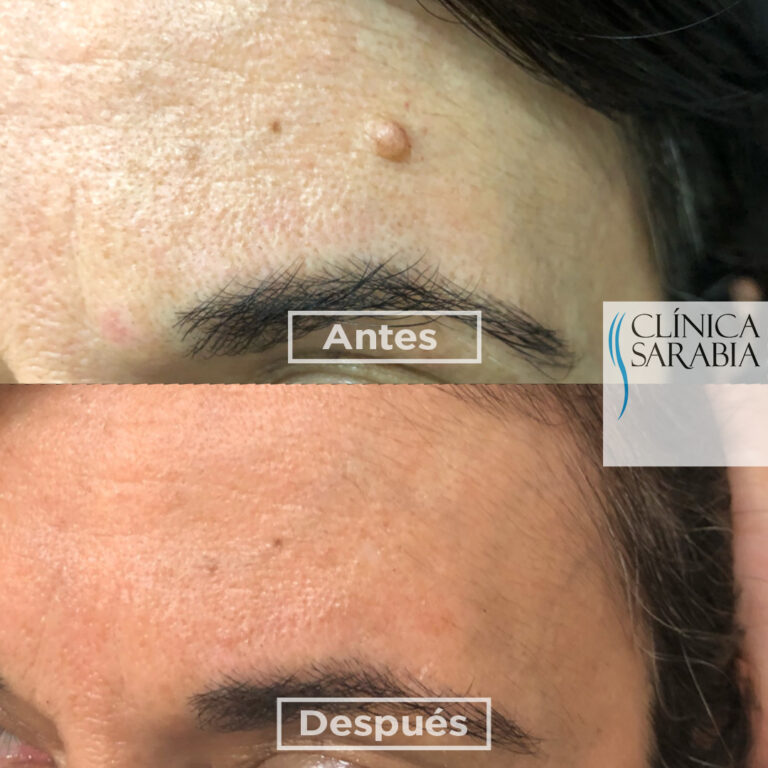 Subida AYD Eliminacion de lesiones cutaneas 01 11 2020