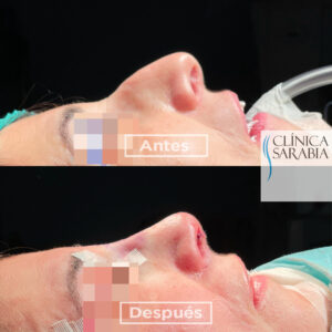Especialistas en rinoplastia en Bilbao 4 Expertos en rinoplastia en Bilbao