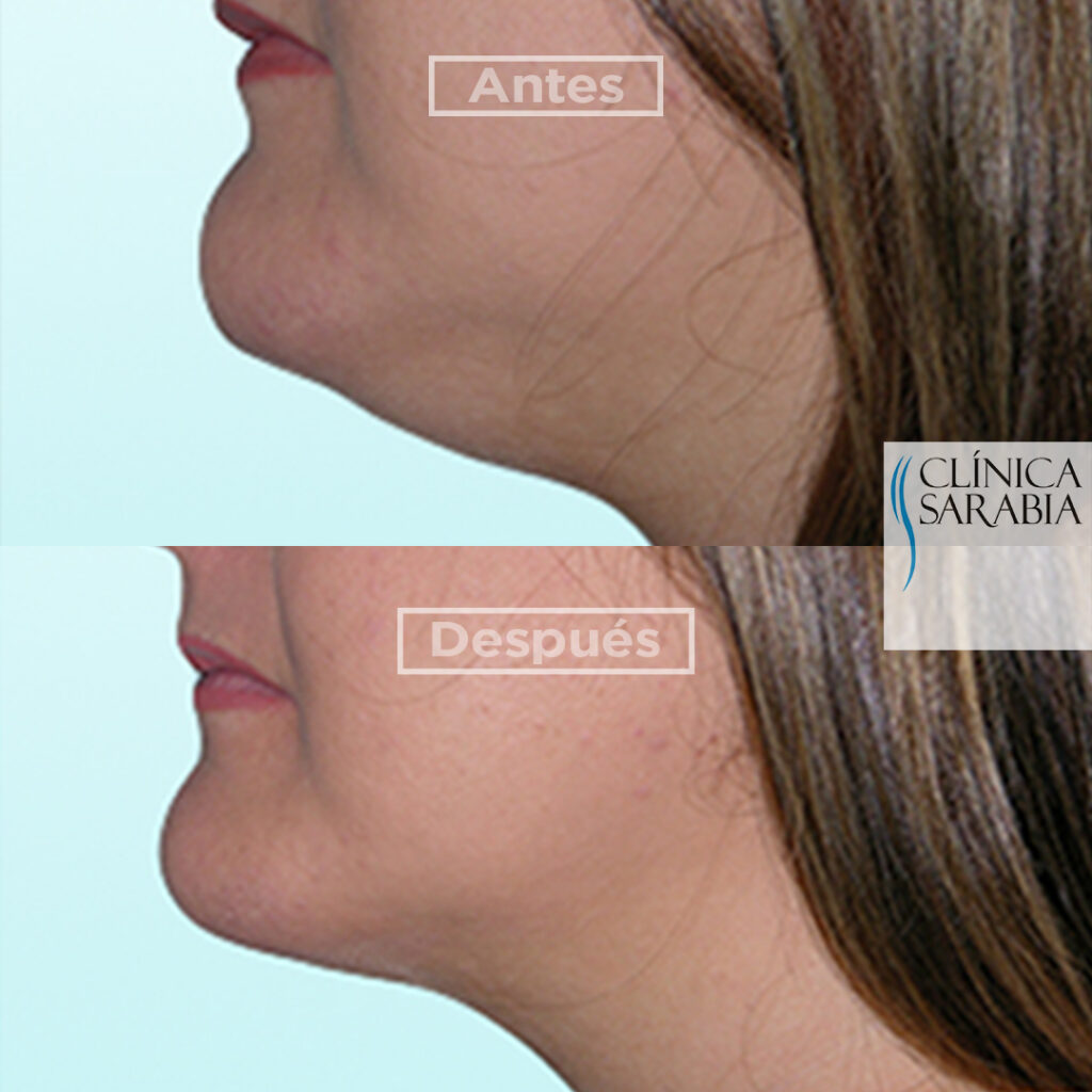 Subida lipo cuello