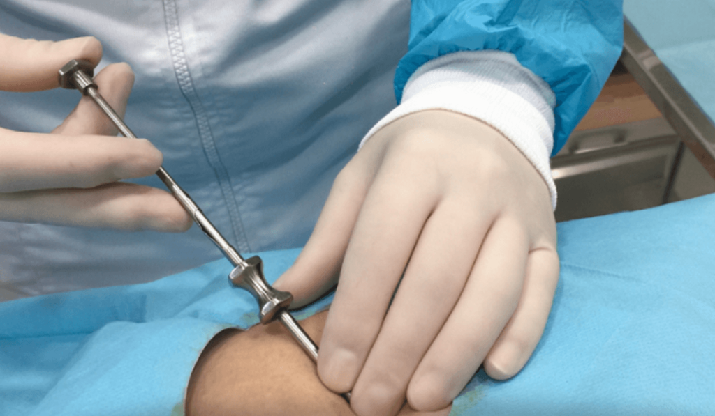 Sotopelle hormonas bioidenticas